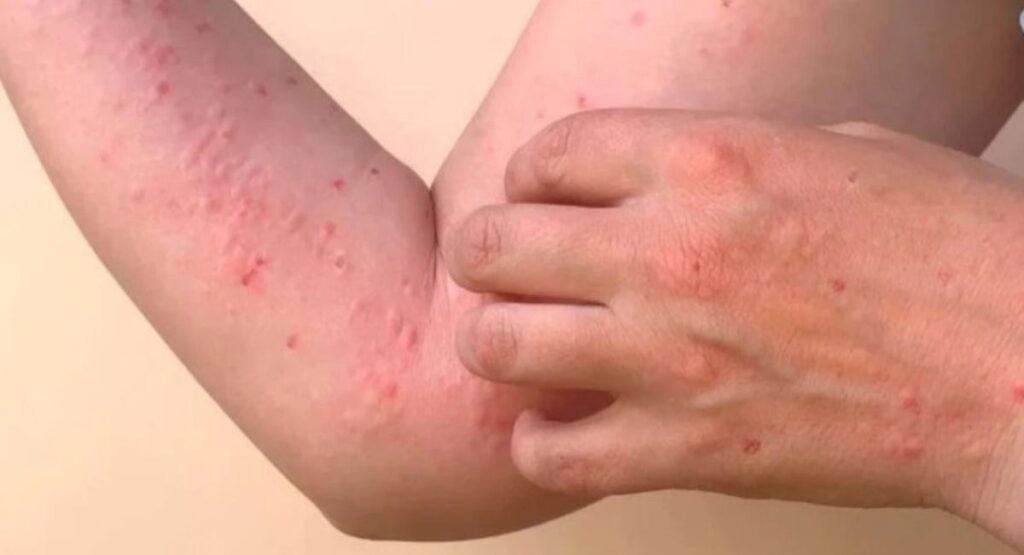 chikungunya cases